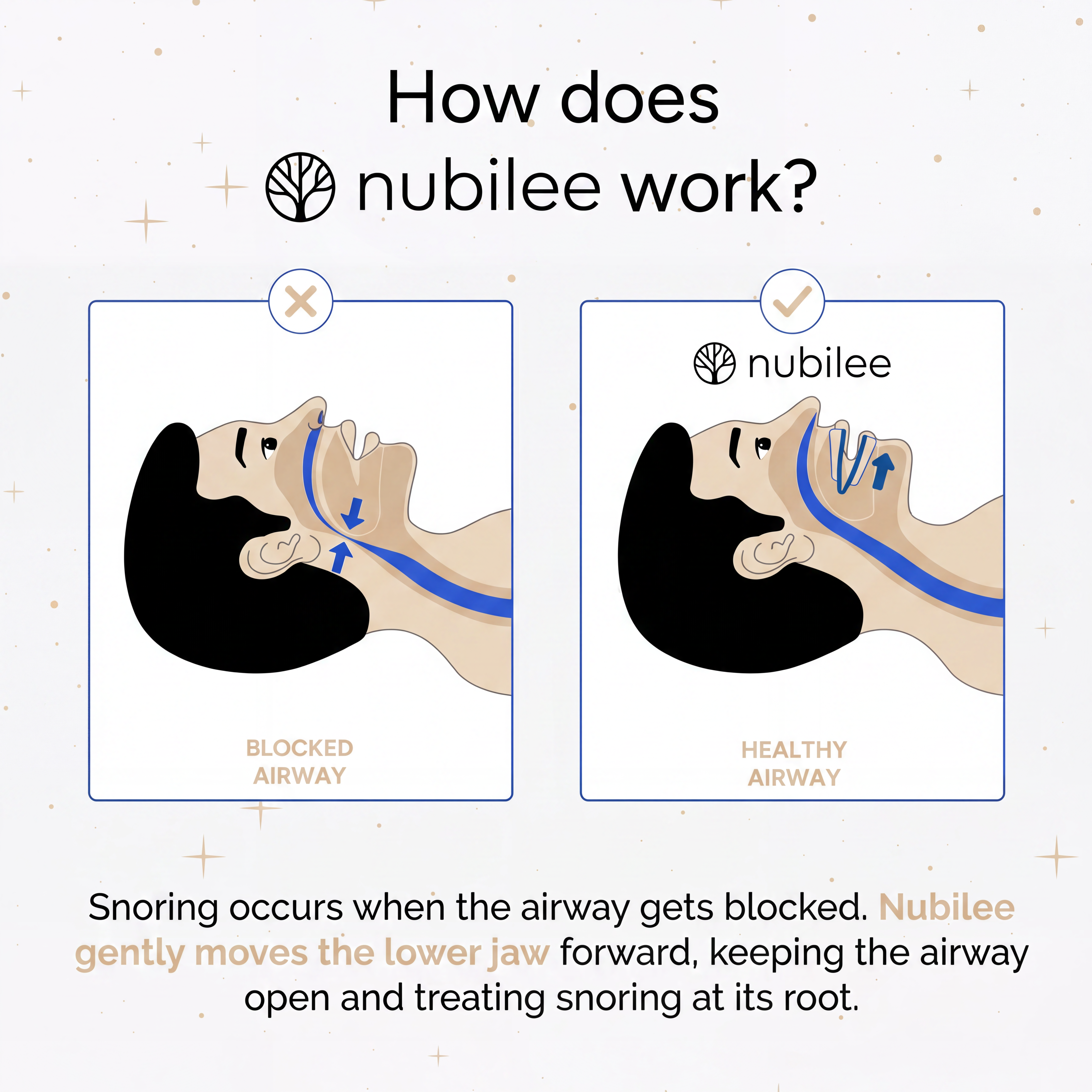 Nubilee™ Pro Snoring Guard